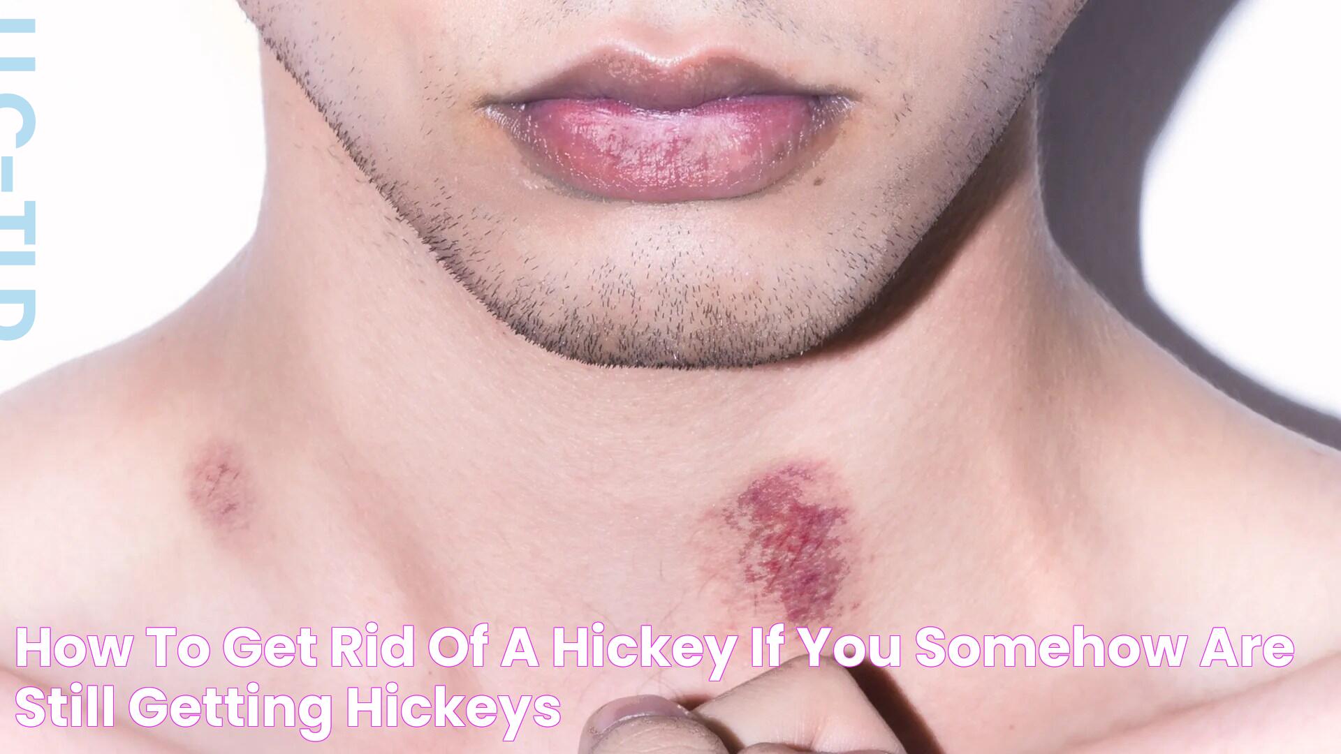 How to get rid of a hickey, if you somehow are still getting hickeys