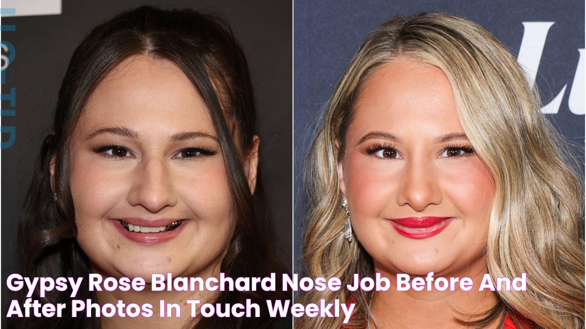 Gypsy Rose Blanchard Nose Job Before and After Photos In Touch Weekly