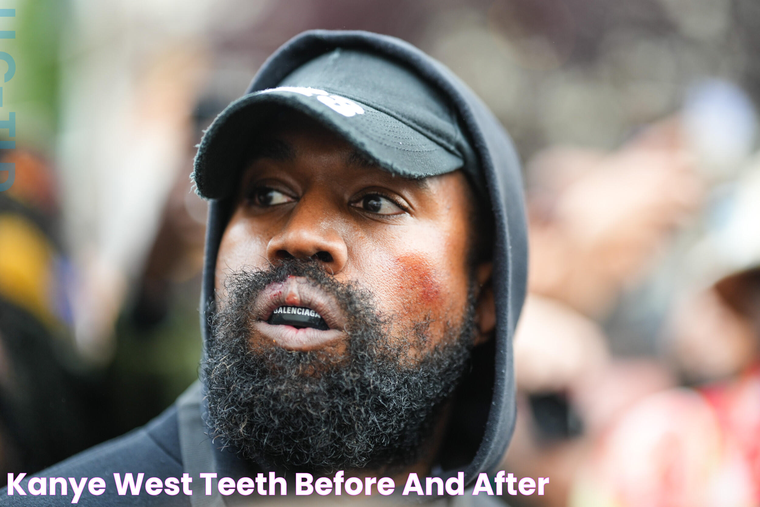 Kanye West Teeth Before And After