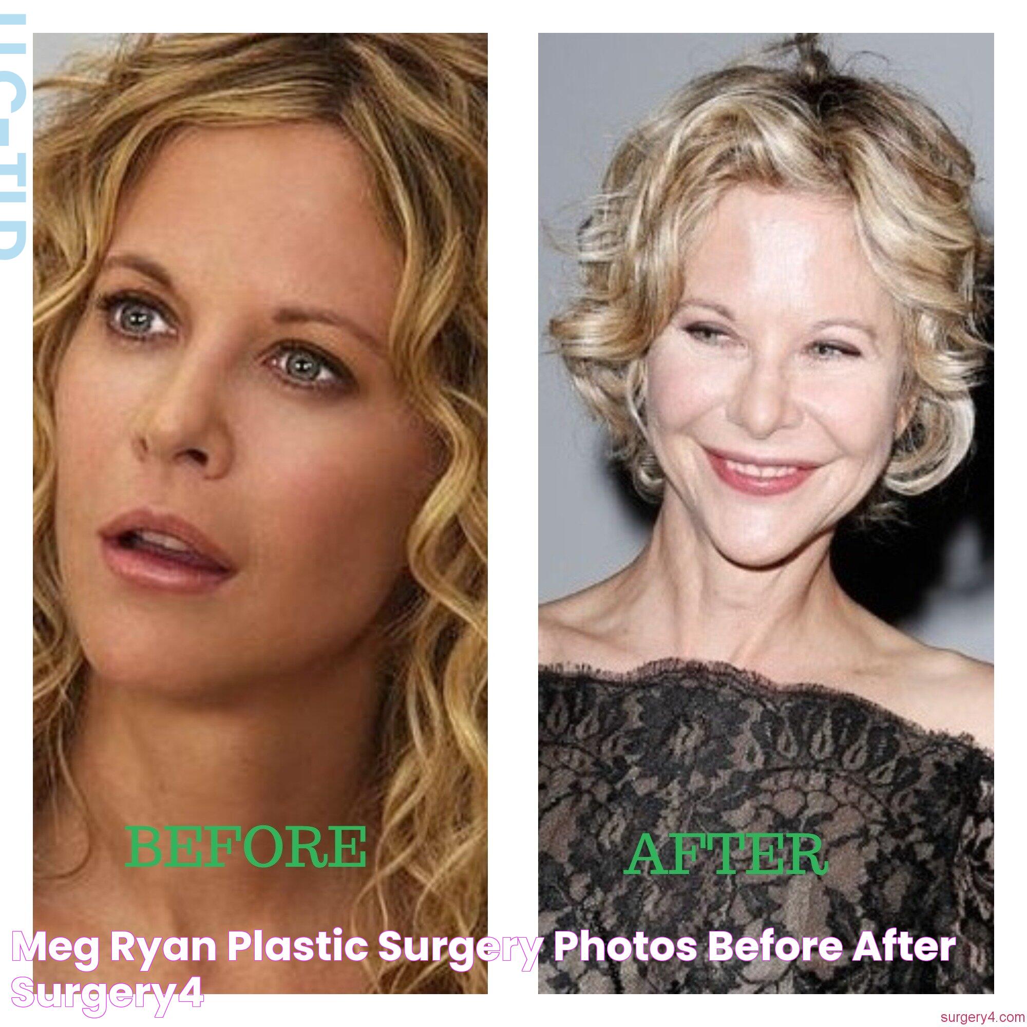 Meg Ryan Plastic Surgery Photos [Before & After] ⋆ Surgery4