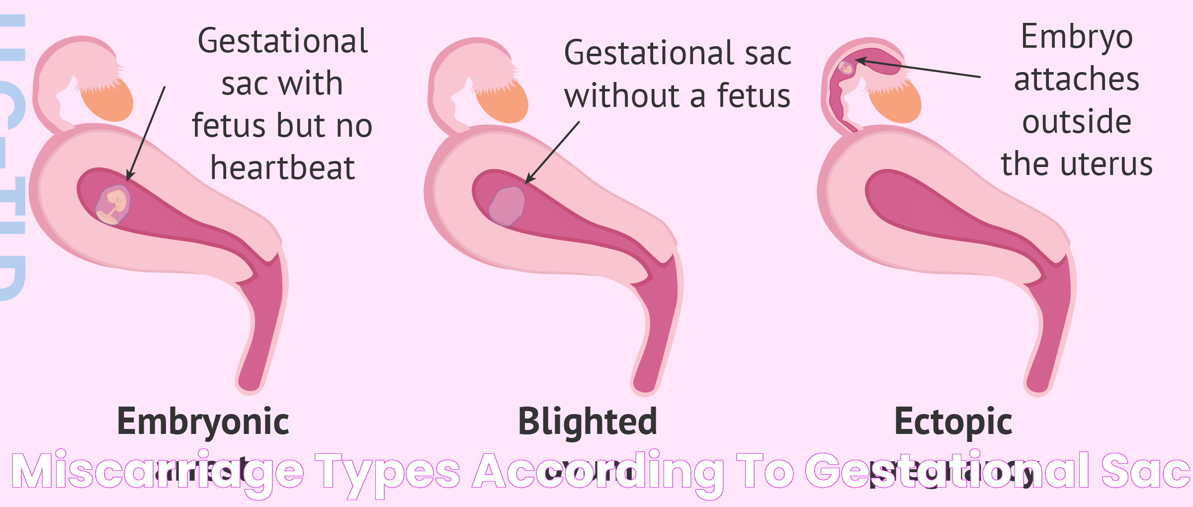 Miscarriage types according to gestational sac